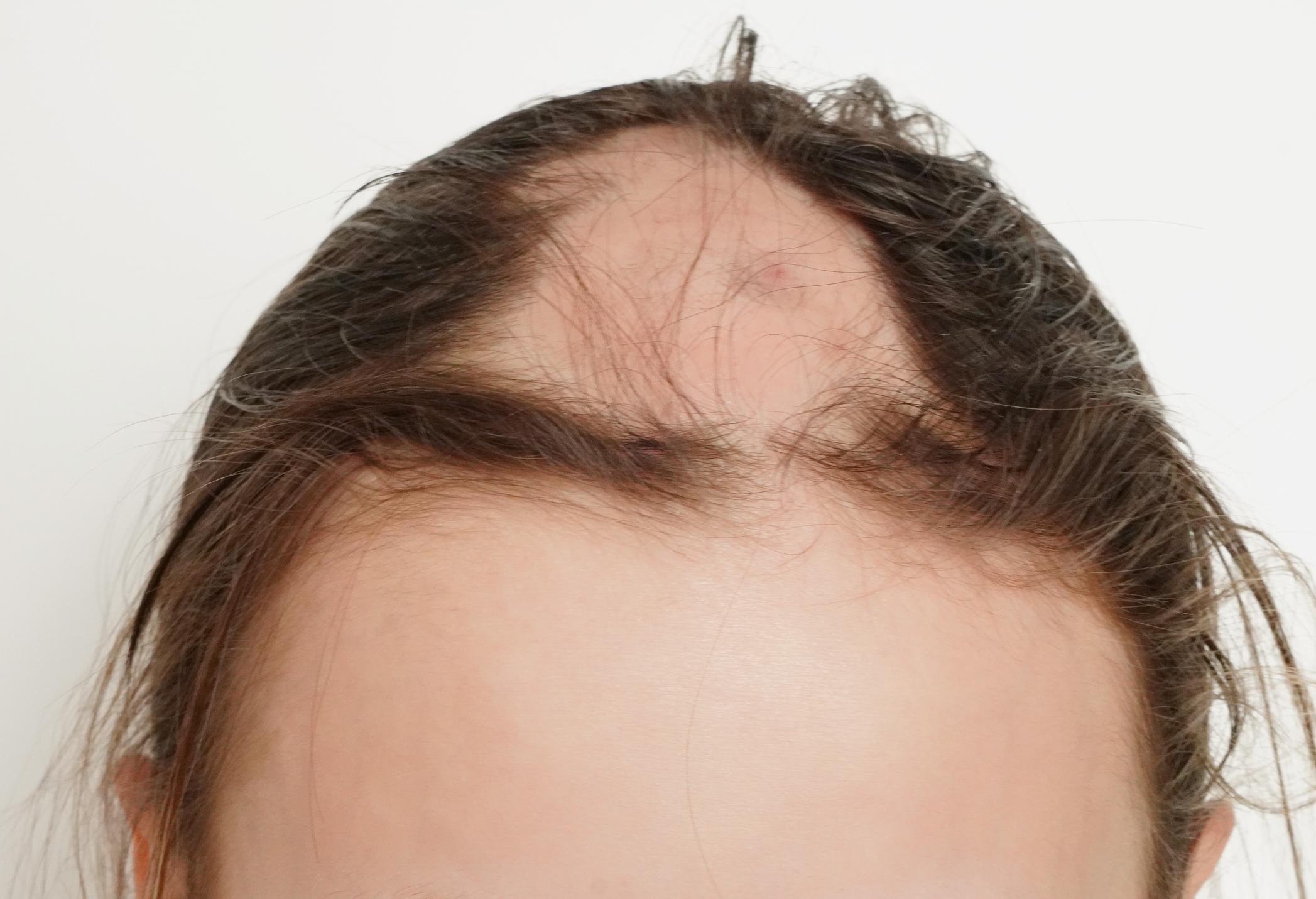 Alopecija – Najbolja Rješenja u BiH: 7 Moćnih Opcija za Samopouzdanje i Prirodni Izgled